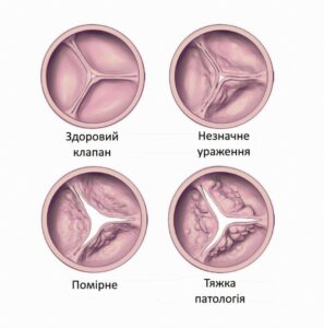 Лікування аортального стенозу в обласній клінічній лікарні Запоріжжя