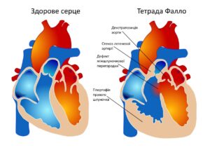 Лікування вроджених вад серця в обласній лікарні Запоріжжя