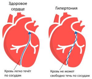 Лечение гипертонии в ЗОКБ