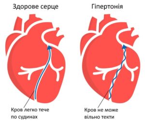 Лікування артеріальної гіпертензії у ЗОКЛ