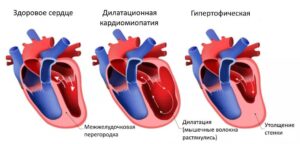 ΠΠ΅ΡΠ΅Π½ΠΈΠ΅ ΠΊΠ°ΡΠ΄ΠΈΠΎΠΌΠΈΠΎΠΏΠ°ΡΠΈΠΈ Π² ΠΠ°ΠΏΠΎΡΠΎΠΆΡΠΊΠΎΠΉ ΠΎΠ±Π»Π°ΡΡΠ½ΠΎΠΉ ΠΊΠ»ΠΈΠ½ΠΈΡΠ΅ΡΠΊΠΎΠΉ Π±ΠΎΠ»ΡΠ½ΠΈΡΠ΅