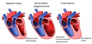 Лікування кардіоміопатії в обласній клінічній лікарні Запоріжжя