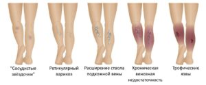 Лечение венозной недостаточности в областной клинической больнице Запорожья