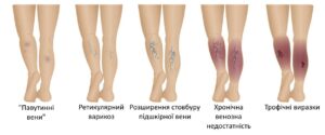Лікування венозної недостатності в обласній лікарні Запоріжжя