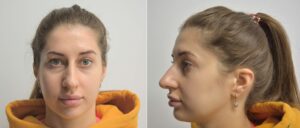 Ринопластика в областной больнице Запорожья