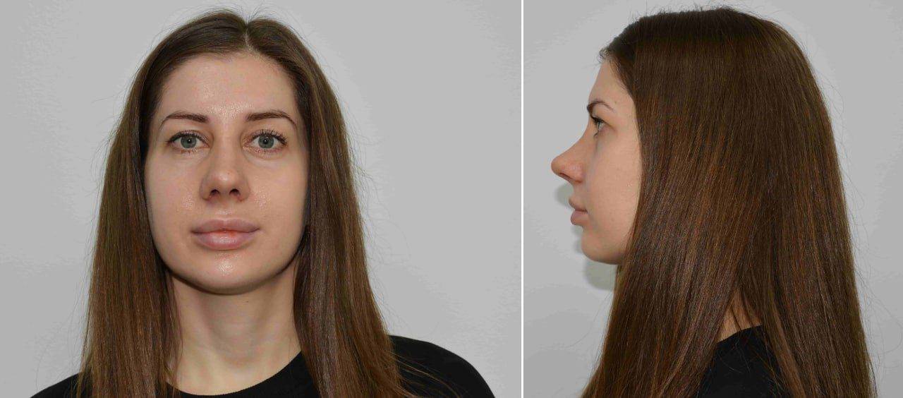 Ринопластика в областной больнице Запорожья 