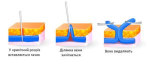 Flebektomiya v oblastnoj bolnitse Zaporozhya ukr