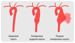 Lechenie ateroskleroza aorty 4 Lechenie ateroskleroza aorty 4
