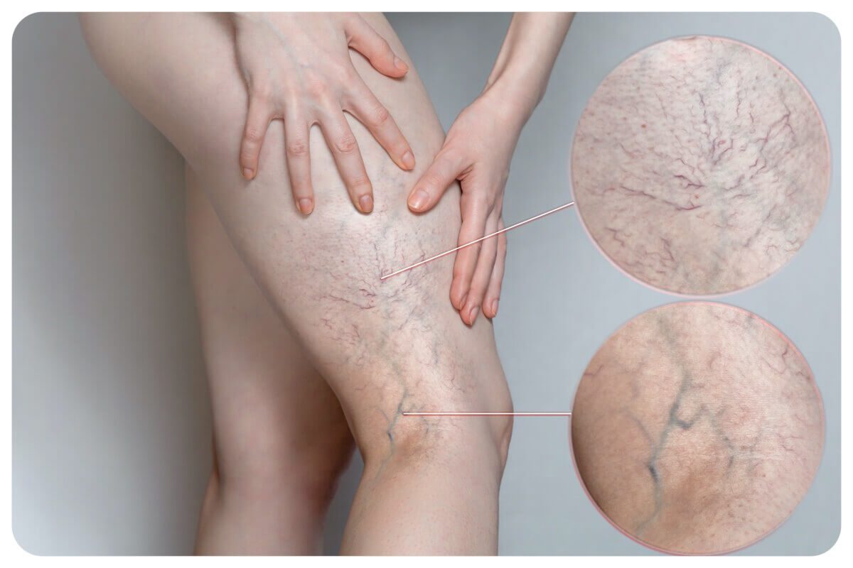 Минифлебэктомия