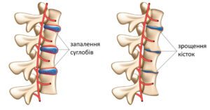 Лечение болезни Бехтерева в областной больнице Запорожья 3