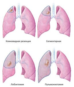 Лобэктомия лёгкого (2)