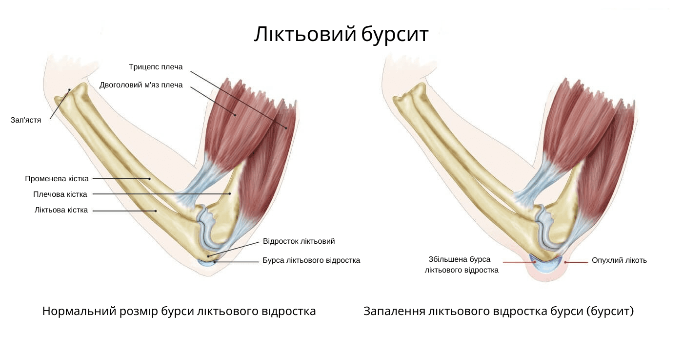 likuvannya bursitu liktovogo sugloba u zaporizhzhi Лікування бурситу ліктьового суглоба у Запоріжжі
