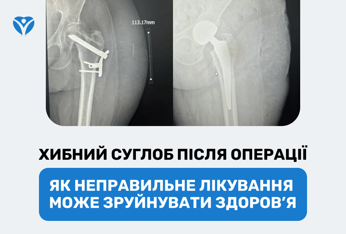 ХИБНИЙ СУГЛОБ ПІСЛЯ ОПЕРАЦІЇ: як неправильне лікування може зруйнувати здоров’я